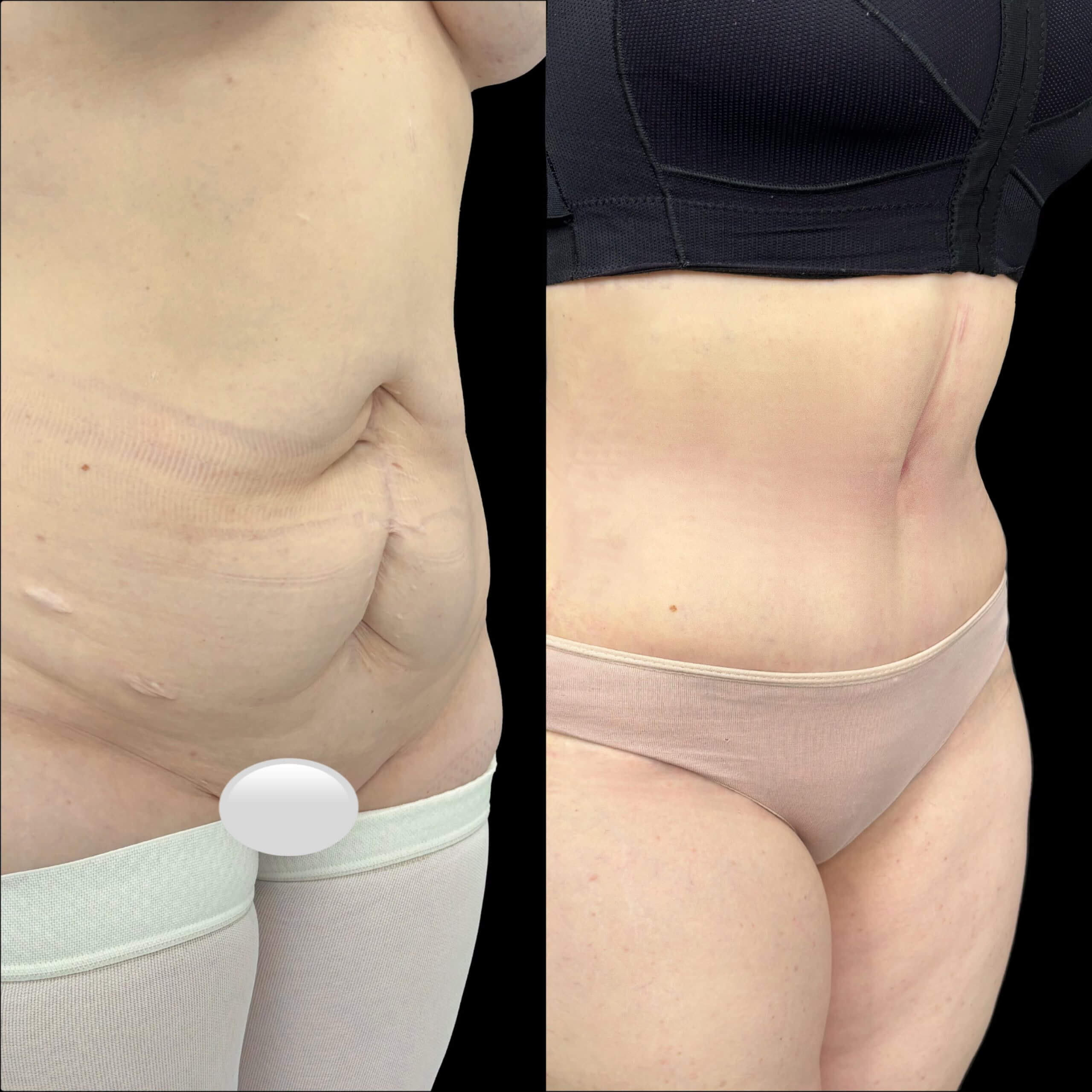 Миниабдоминопластика 01