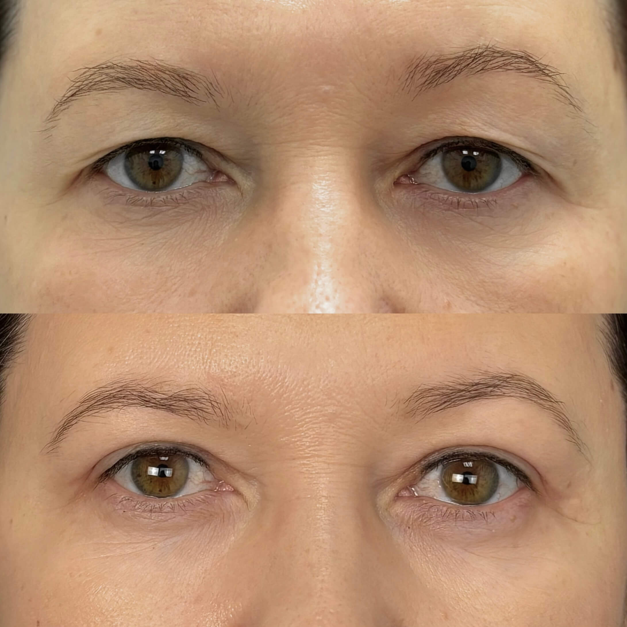 Нижняя блефаропластика 01