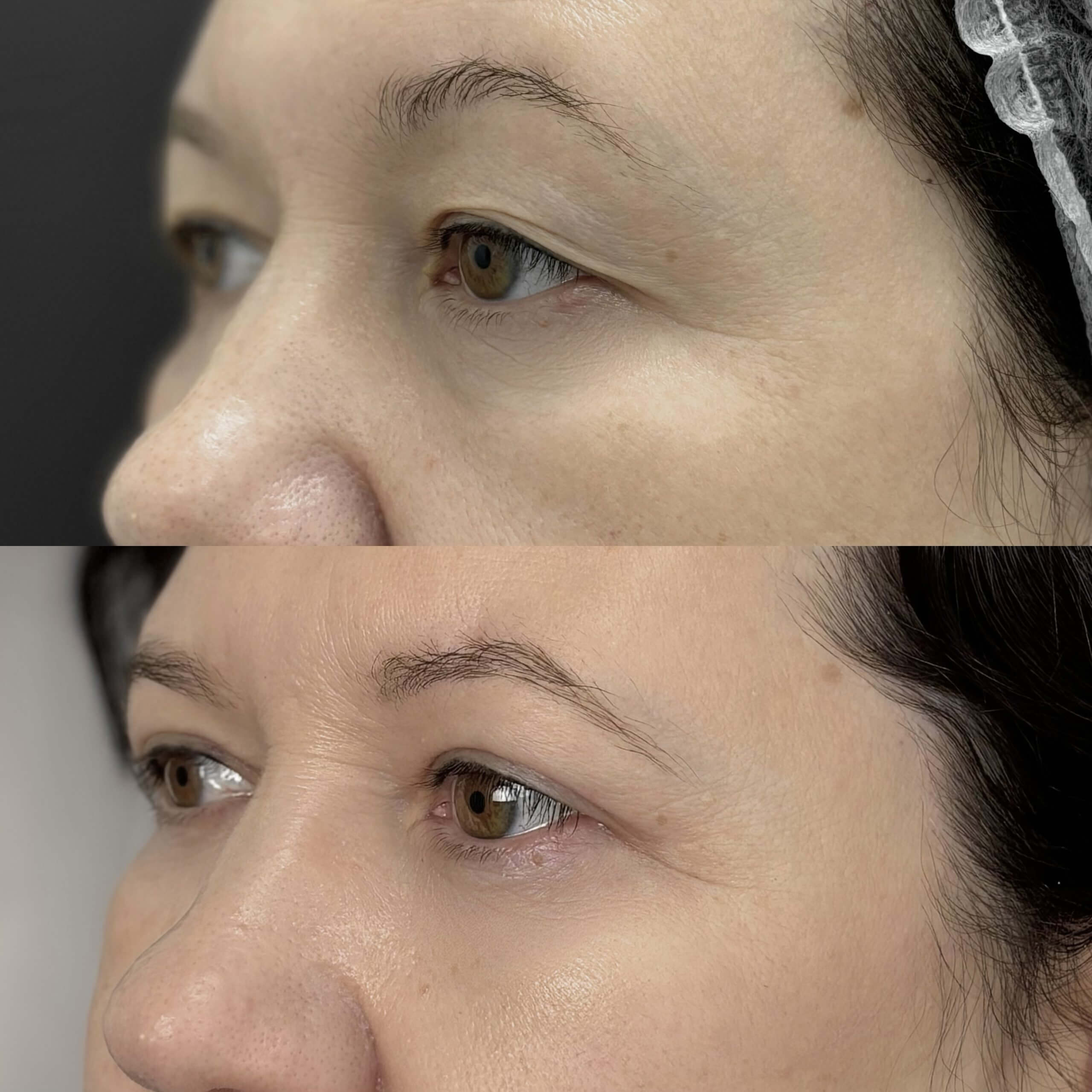 Нижняя блефаропластика 01