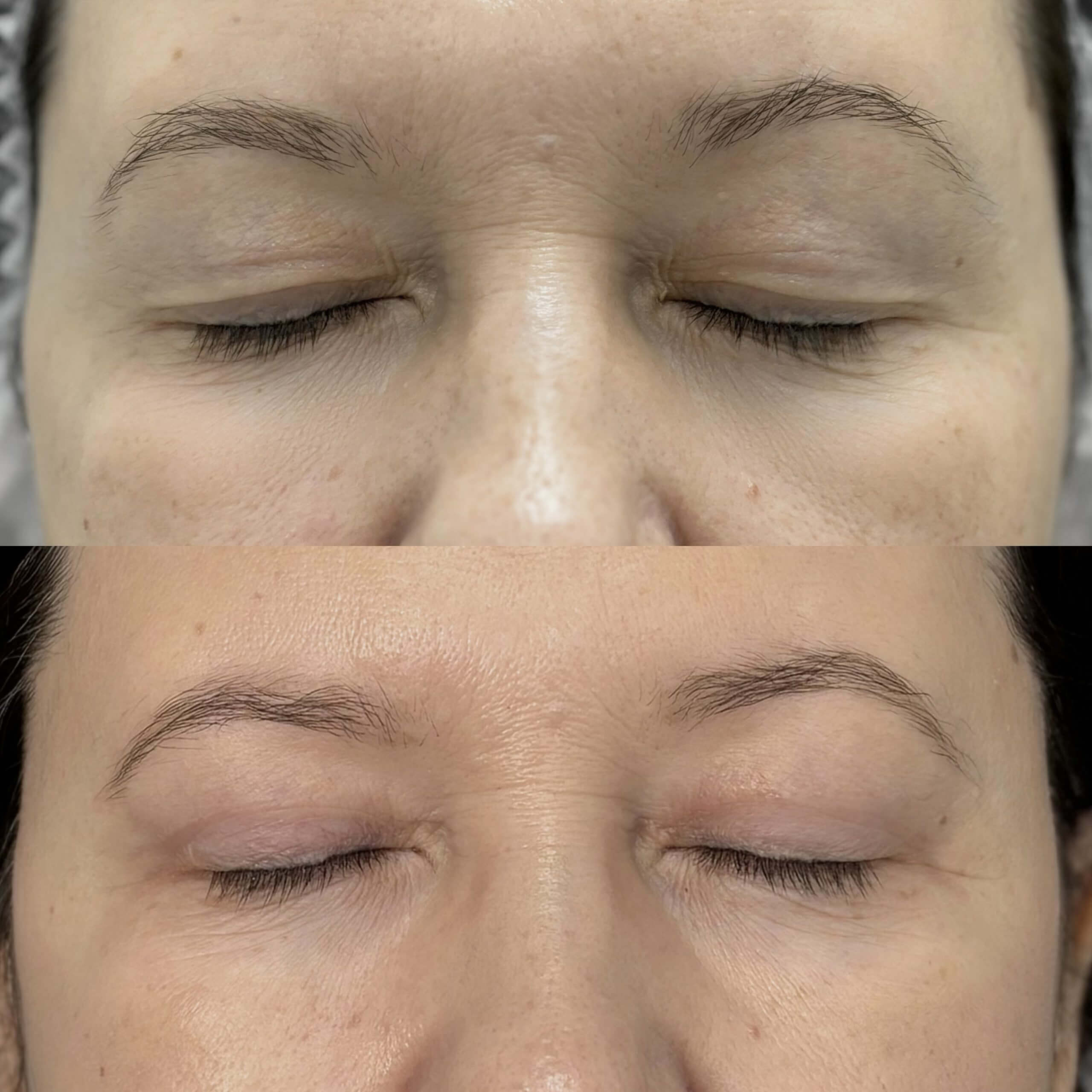 Нижняя блефаропластика 01