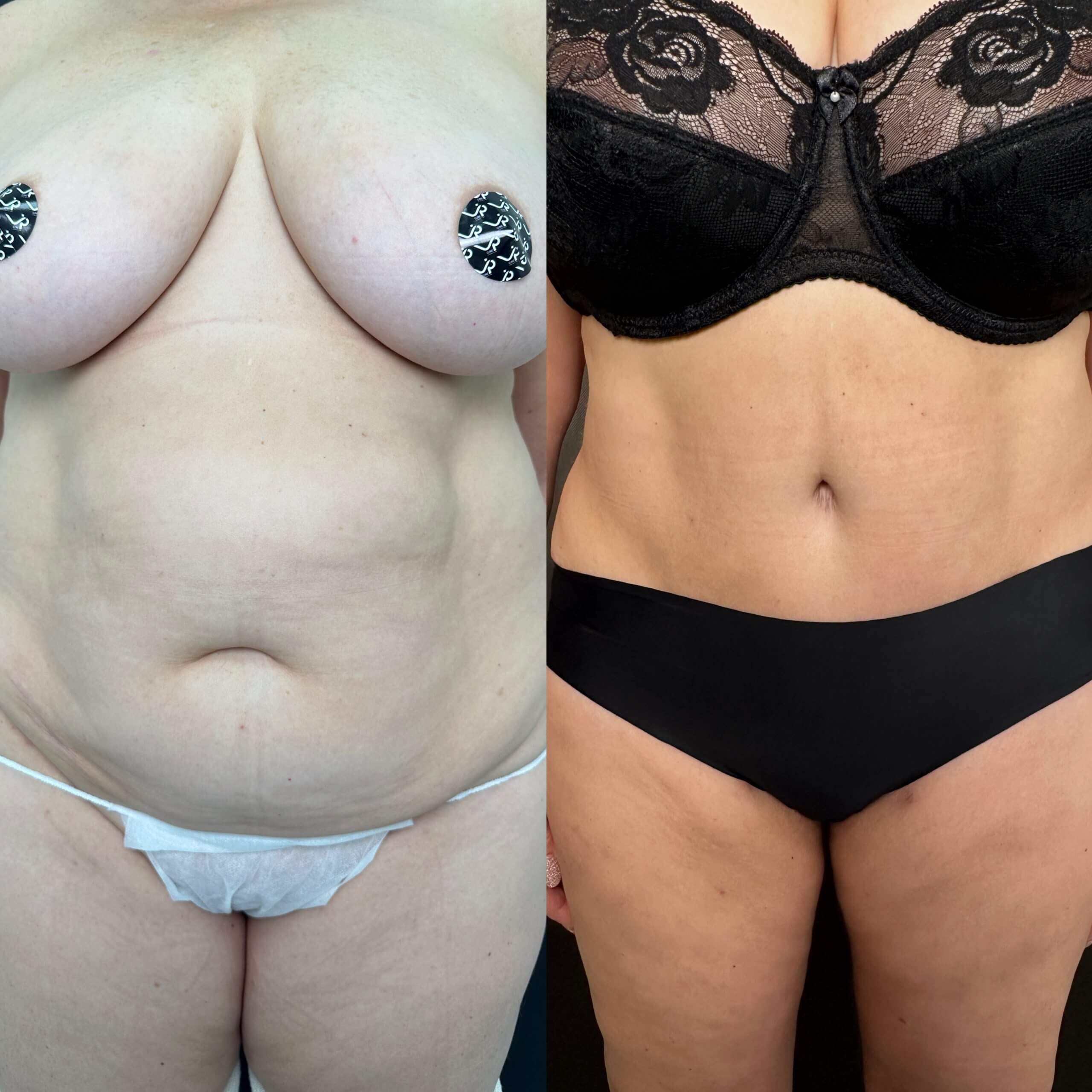 Ушивание диастаза 01