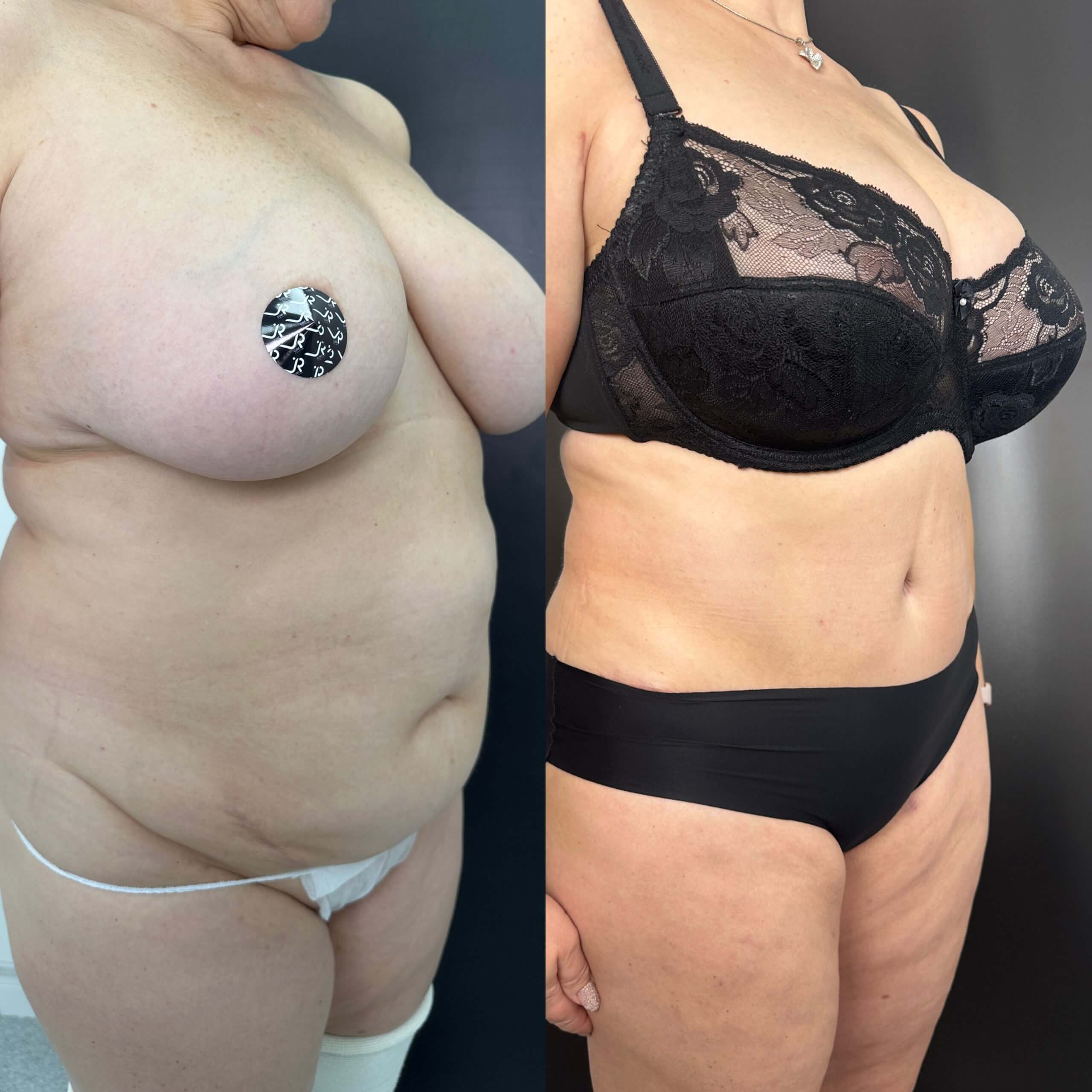 Ушивание диастаза 01