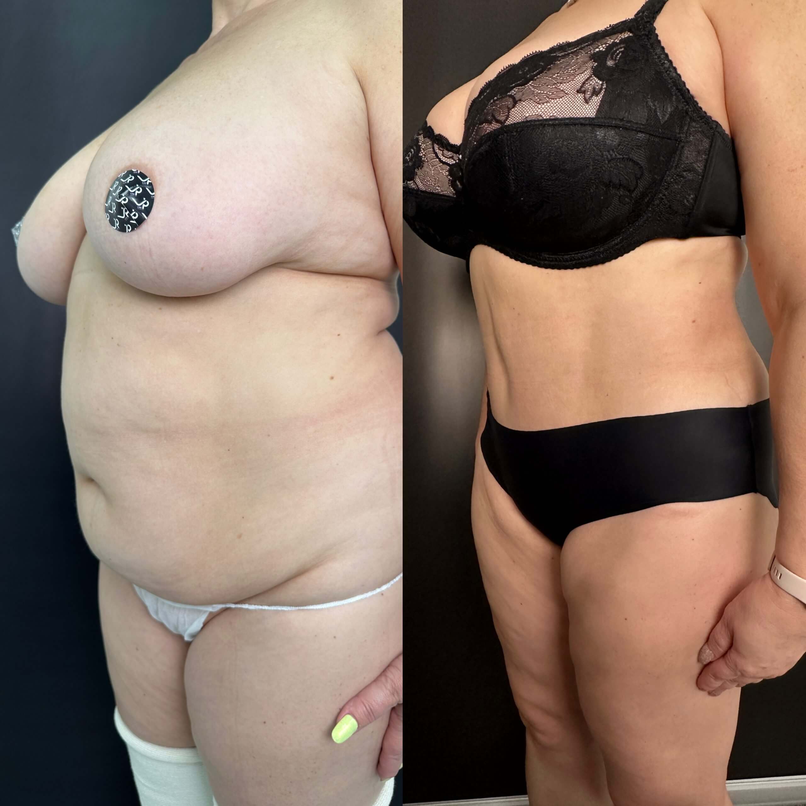 Ушивание диастаза 01