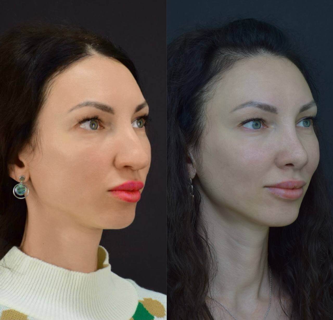 Ринопластика 01