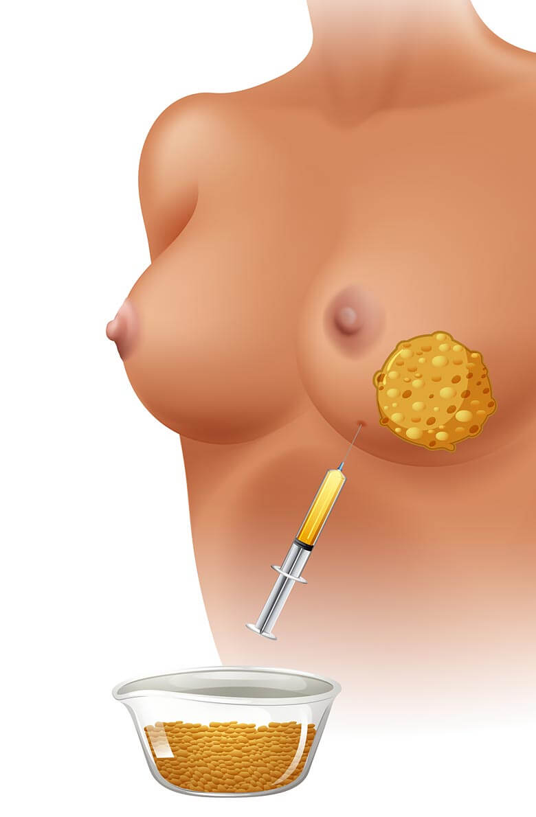 Липофилинг груди