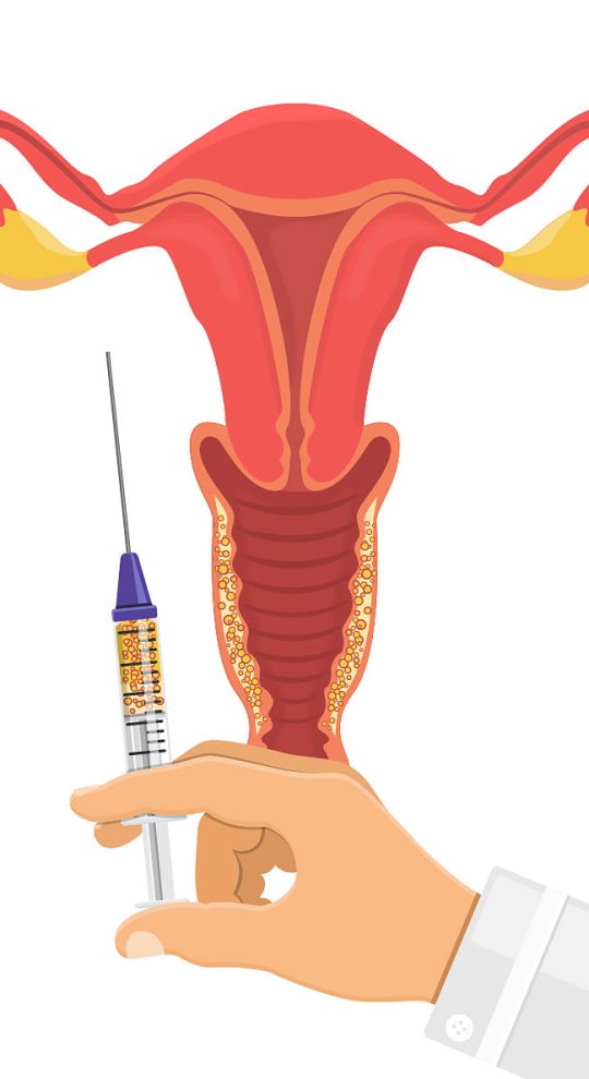 Липофилинг интимной зоны