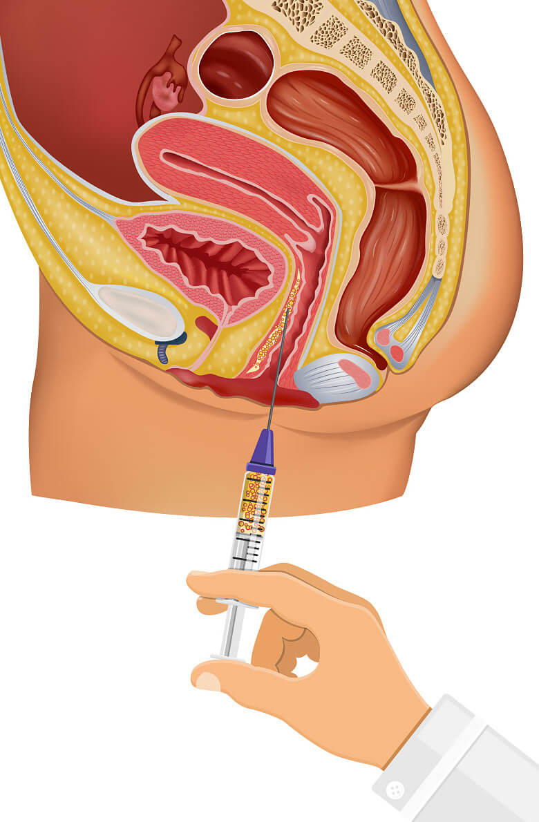 lipofiling-intimnoy-zony-2