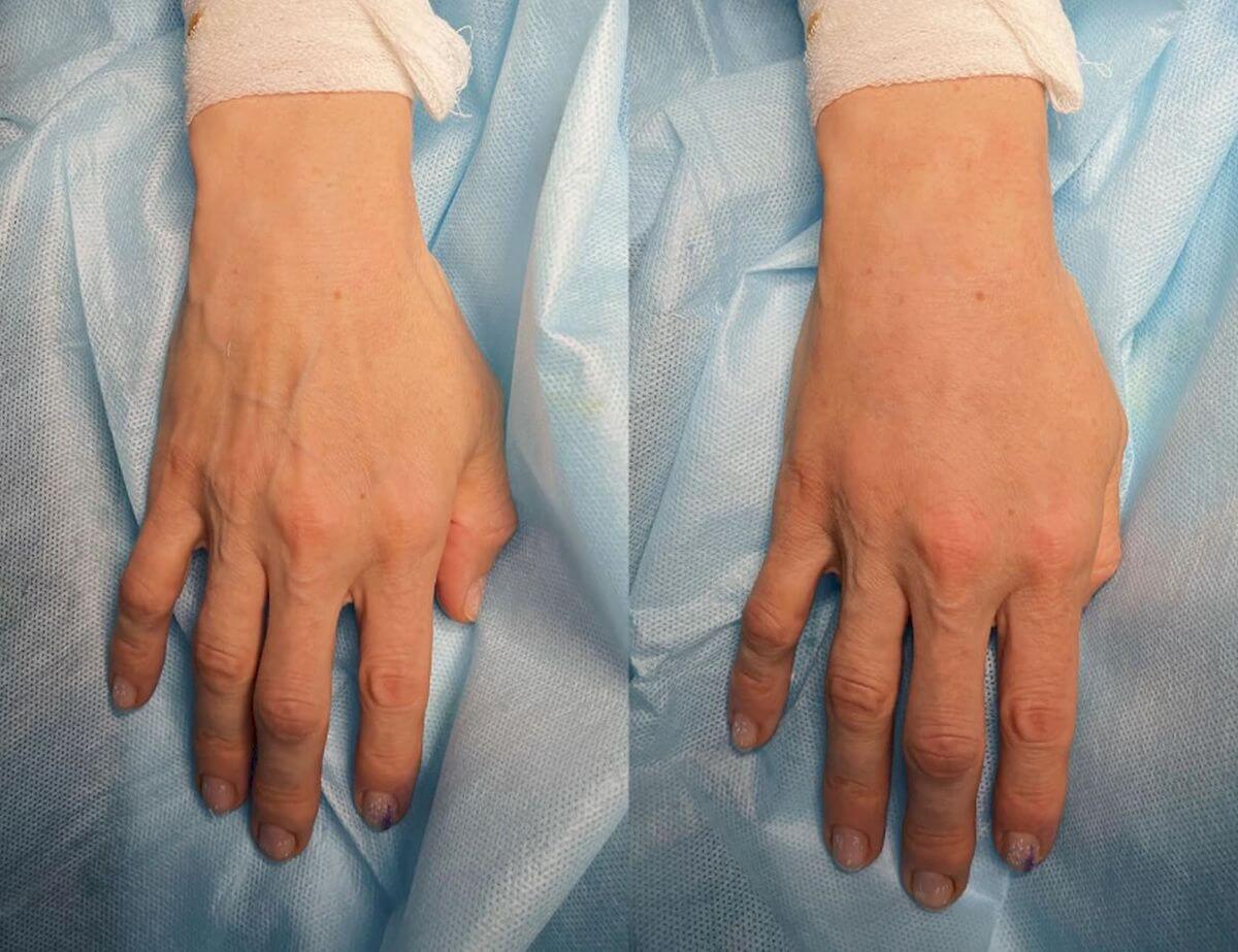 Липофилинг кистей рук 01