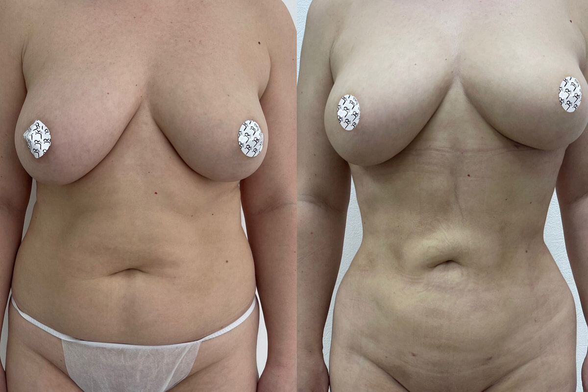 Липомоделирование тела 01