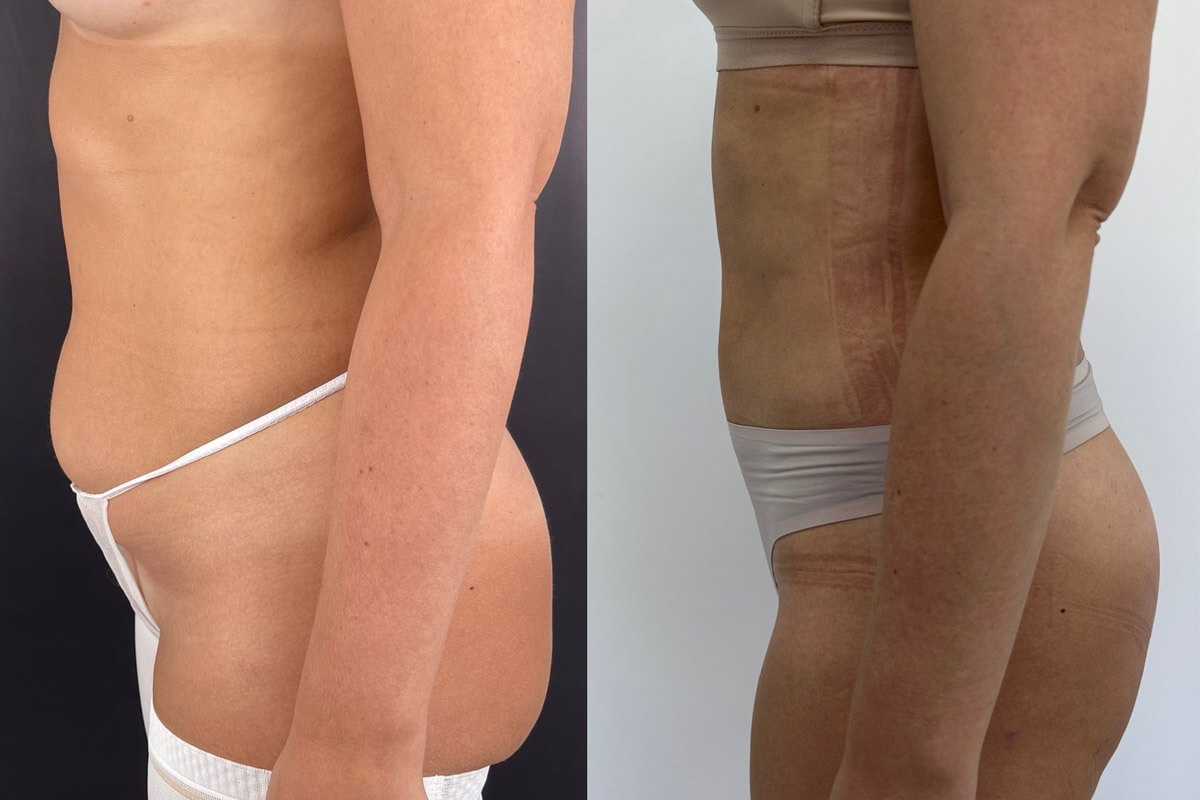 Липомоделирование тела 01