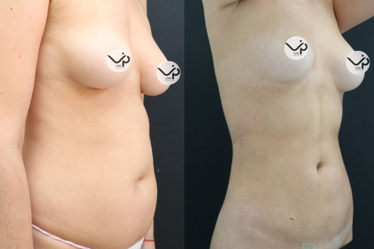 Липомоделирование тела 01