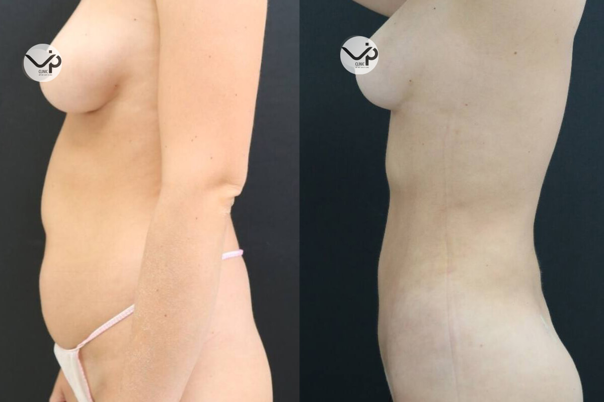 Липомоделирование тела 01