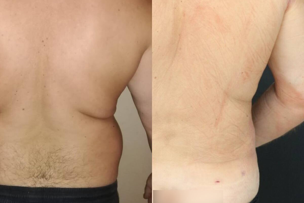 Липомоделирование тела 01