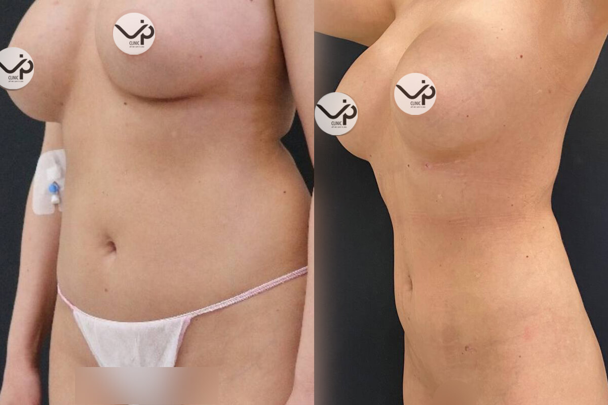 Липомоделирование тела 01