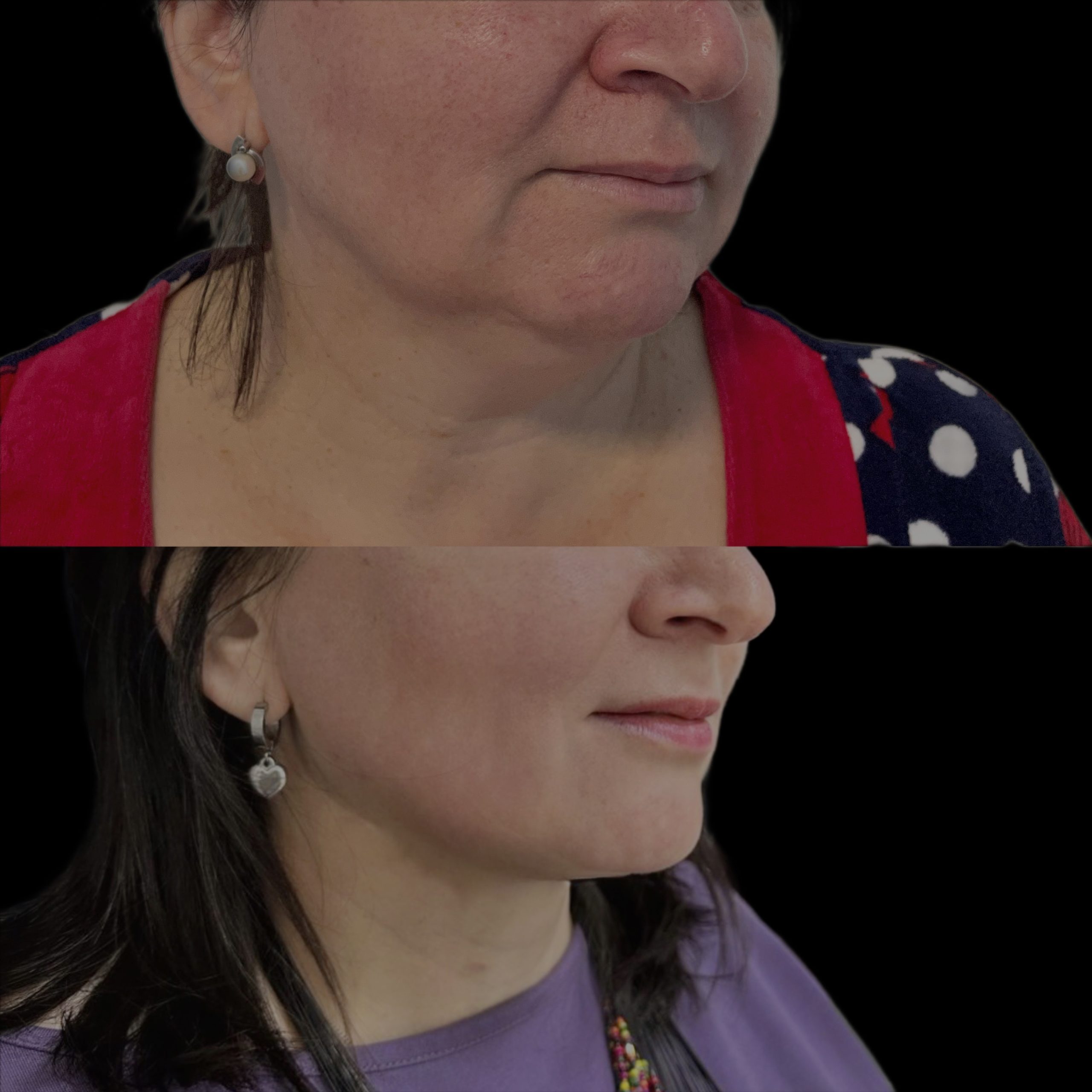 Липосакция подбородка и шеи 01