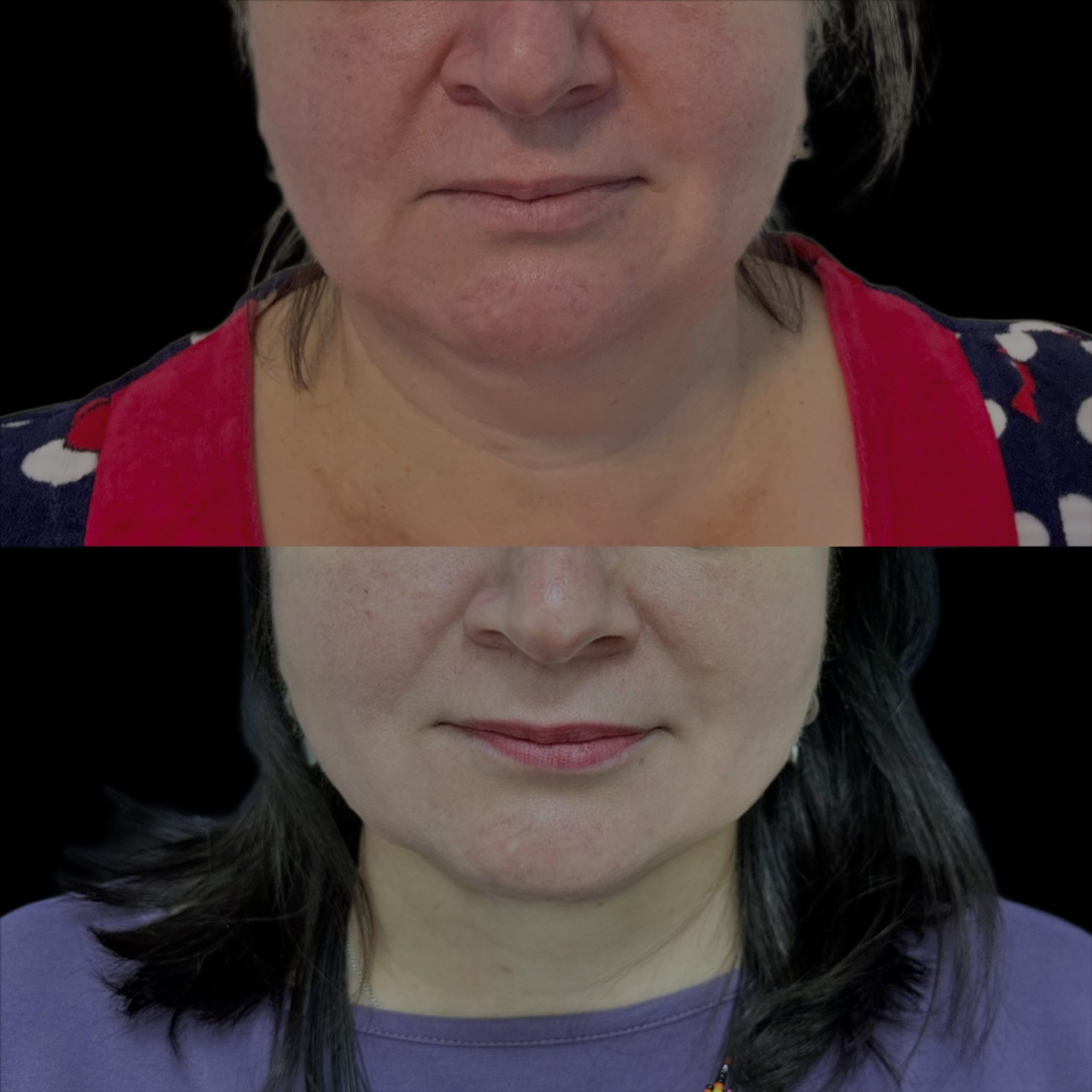 Липосакция подбородка и шеи 01