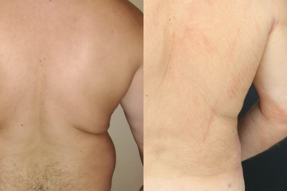 Липосакция живота и боков 01