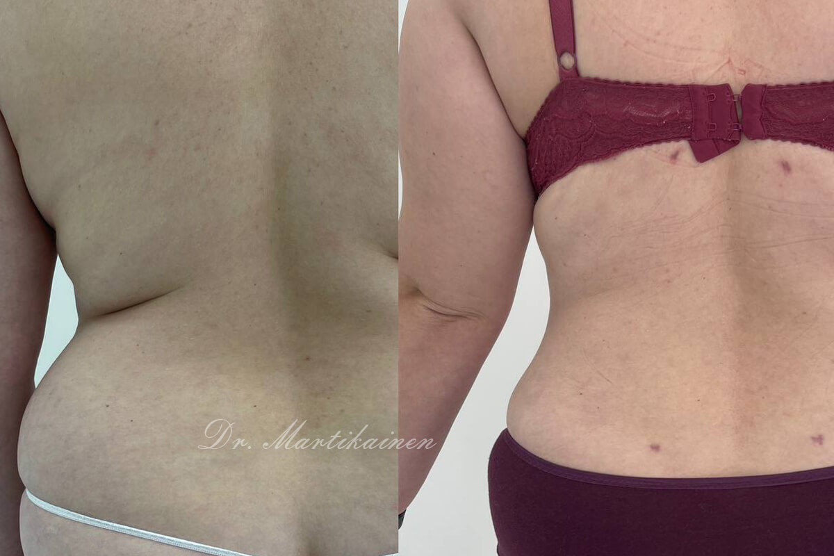 Липосакция живота и боков 01