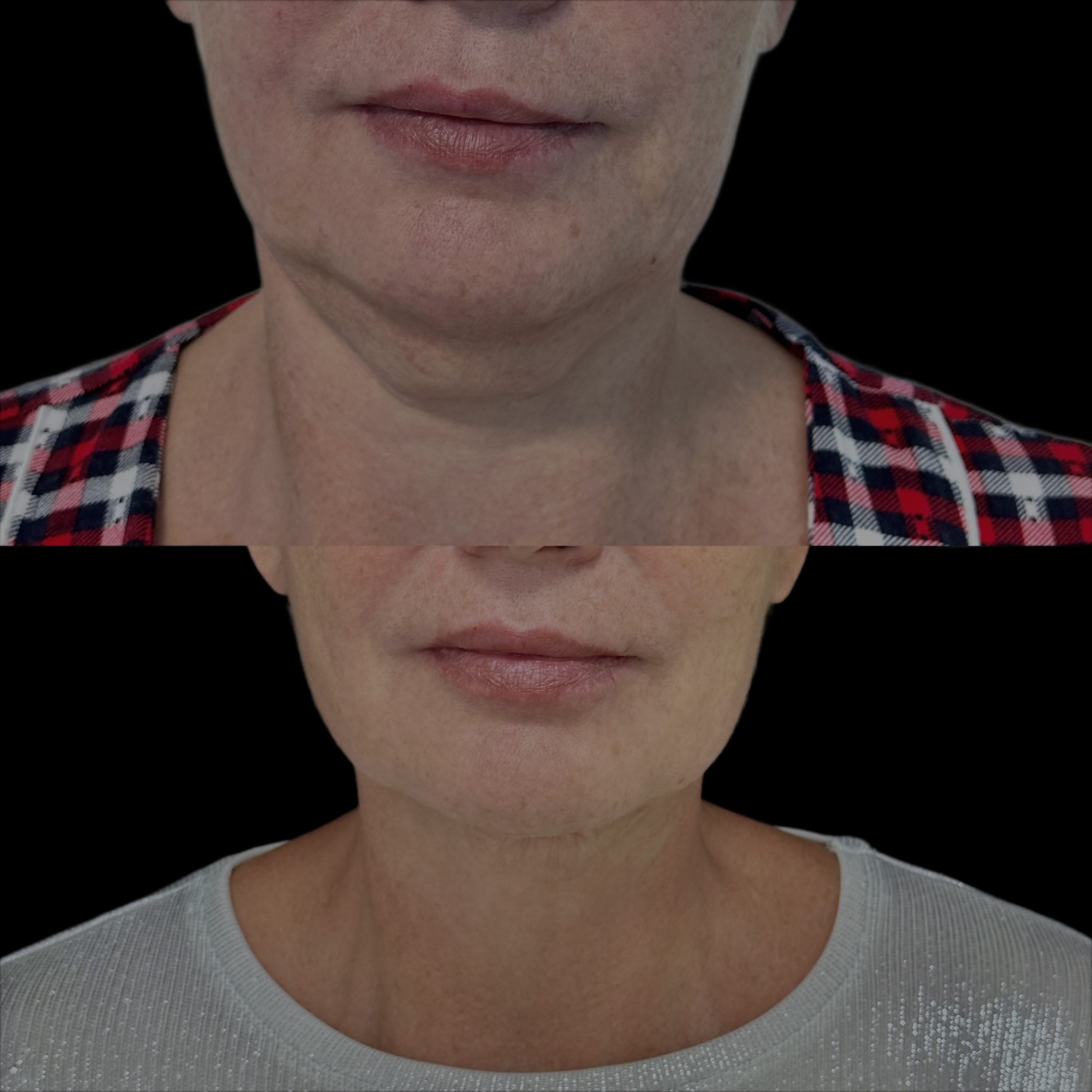 Липосакция подбородка и шеи 01