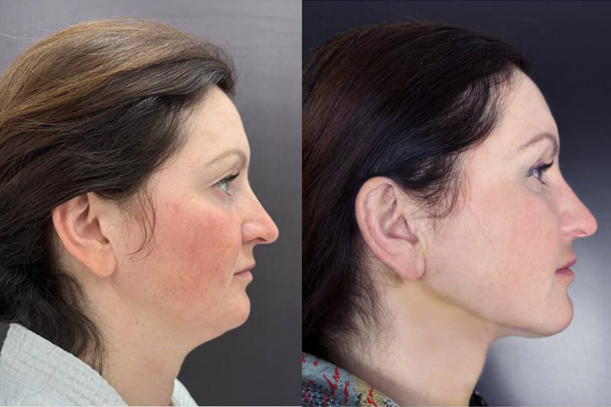 Липосакция подбородка и шеи 01