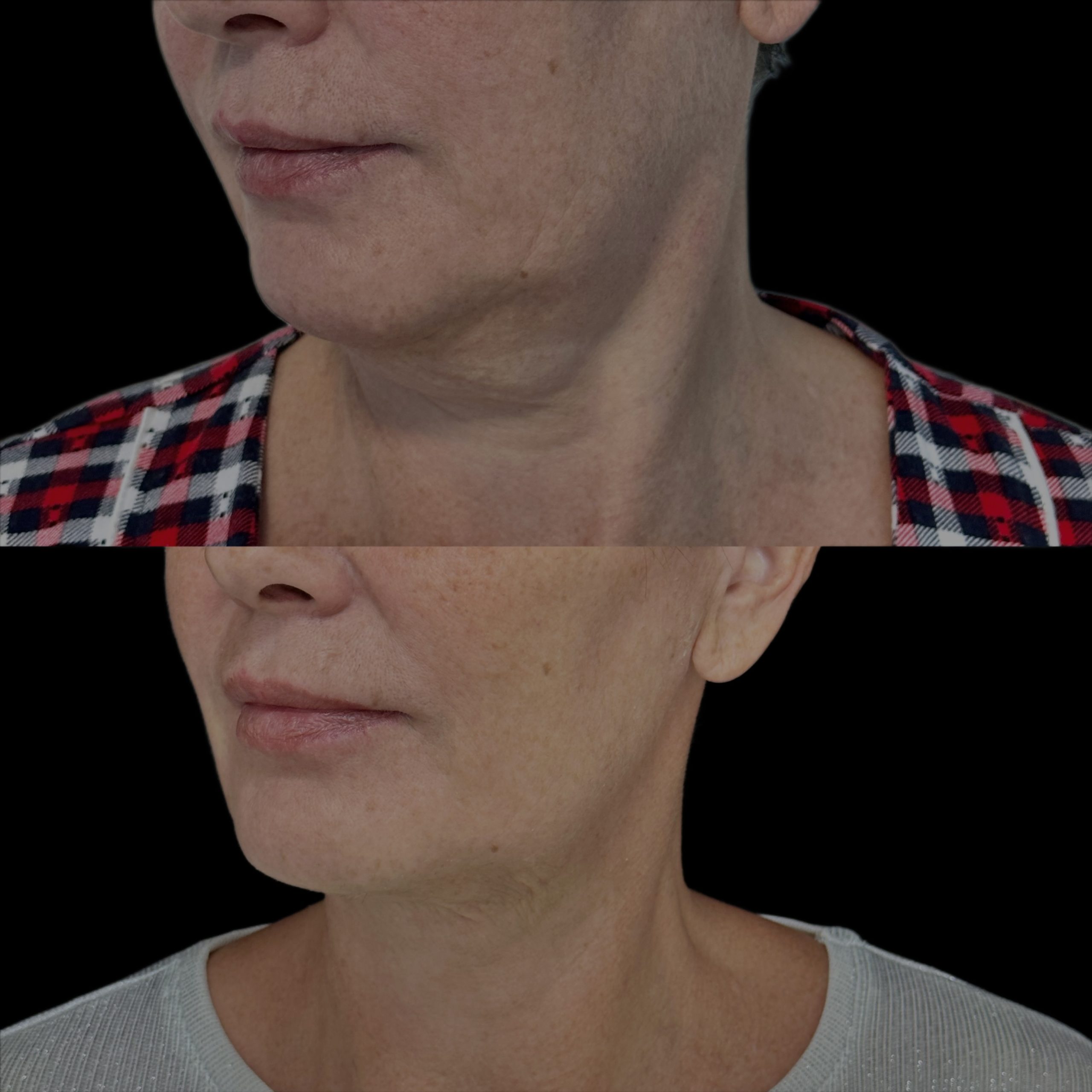 Липосакция подбородка и шеи 01