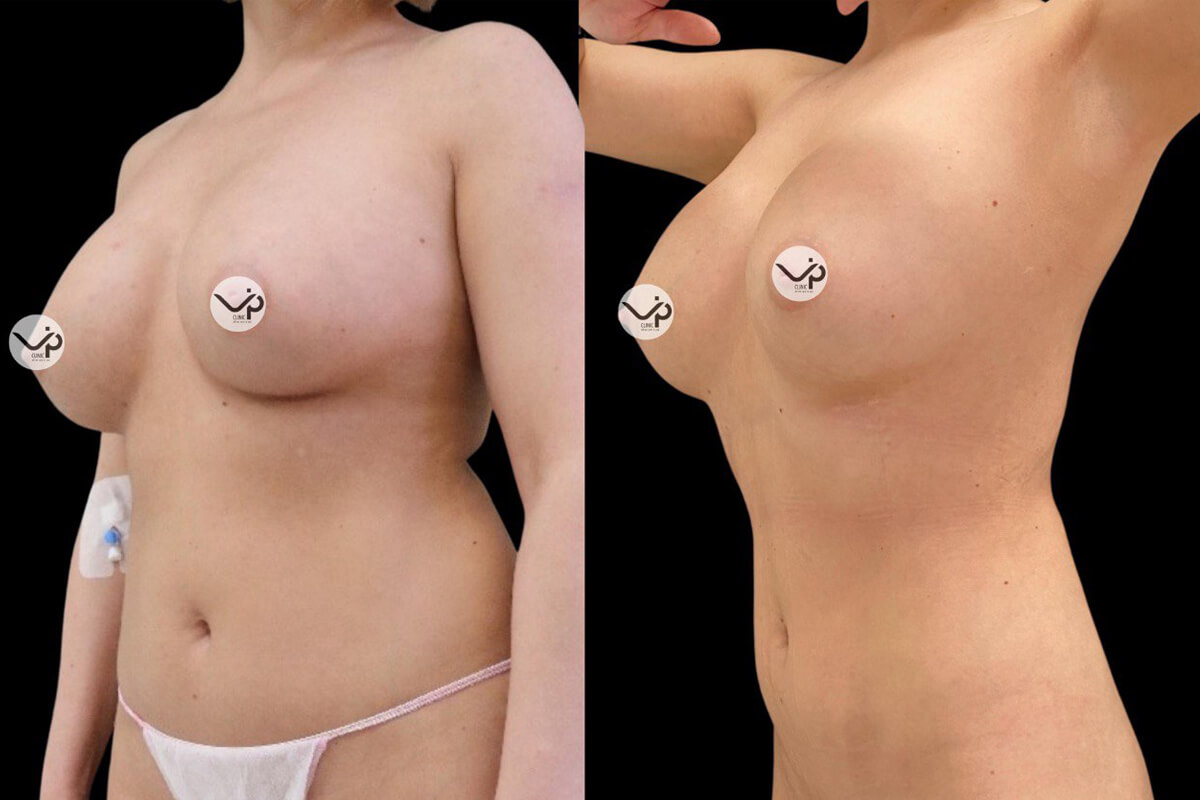 Липосакция живота и боков 01