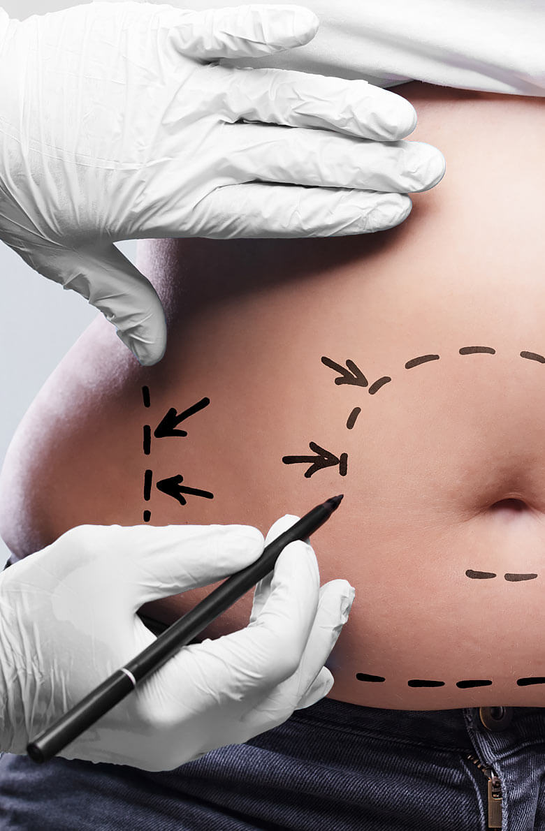Липосакция живота и боков