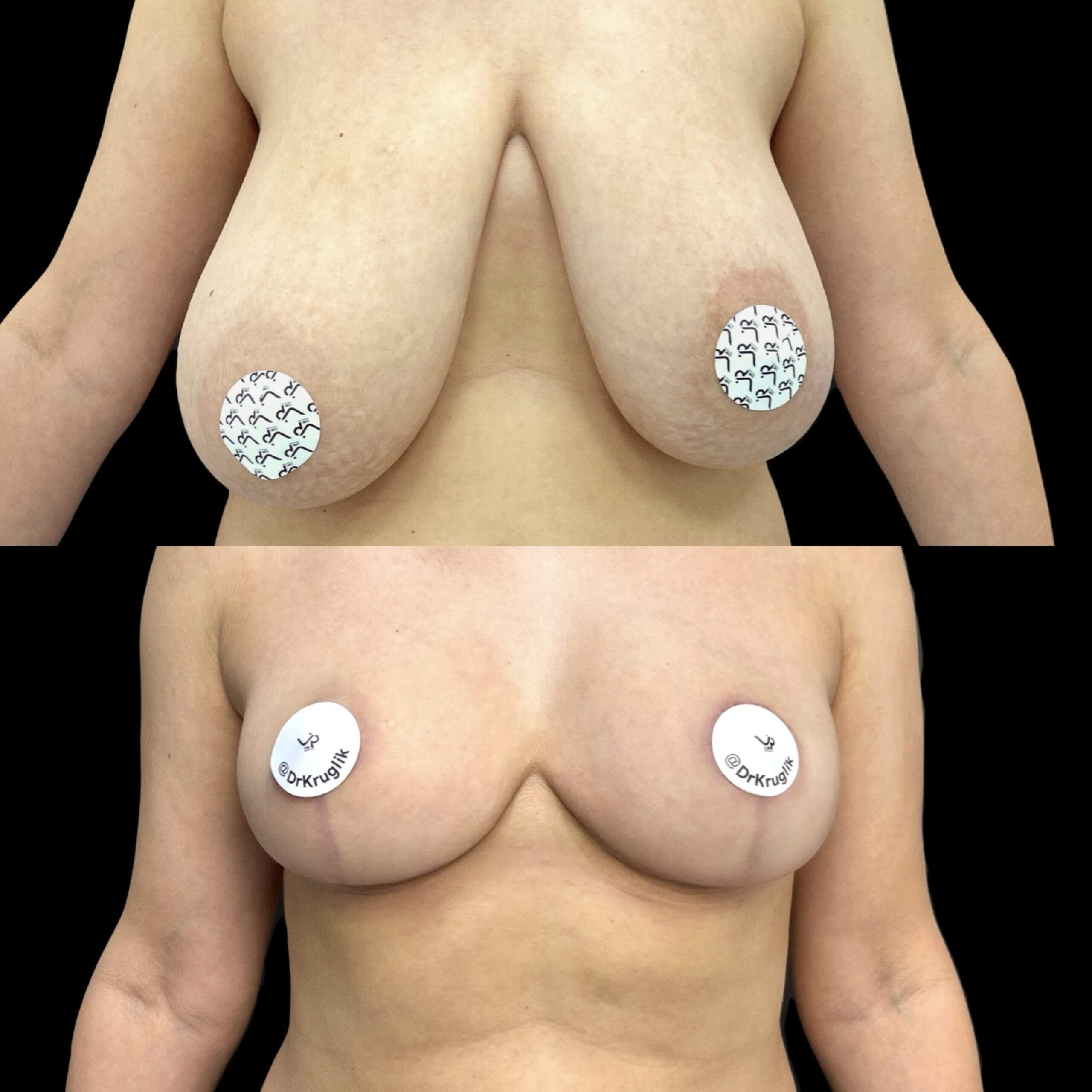 Подтяжка груди (мастопексия) 01