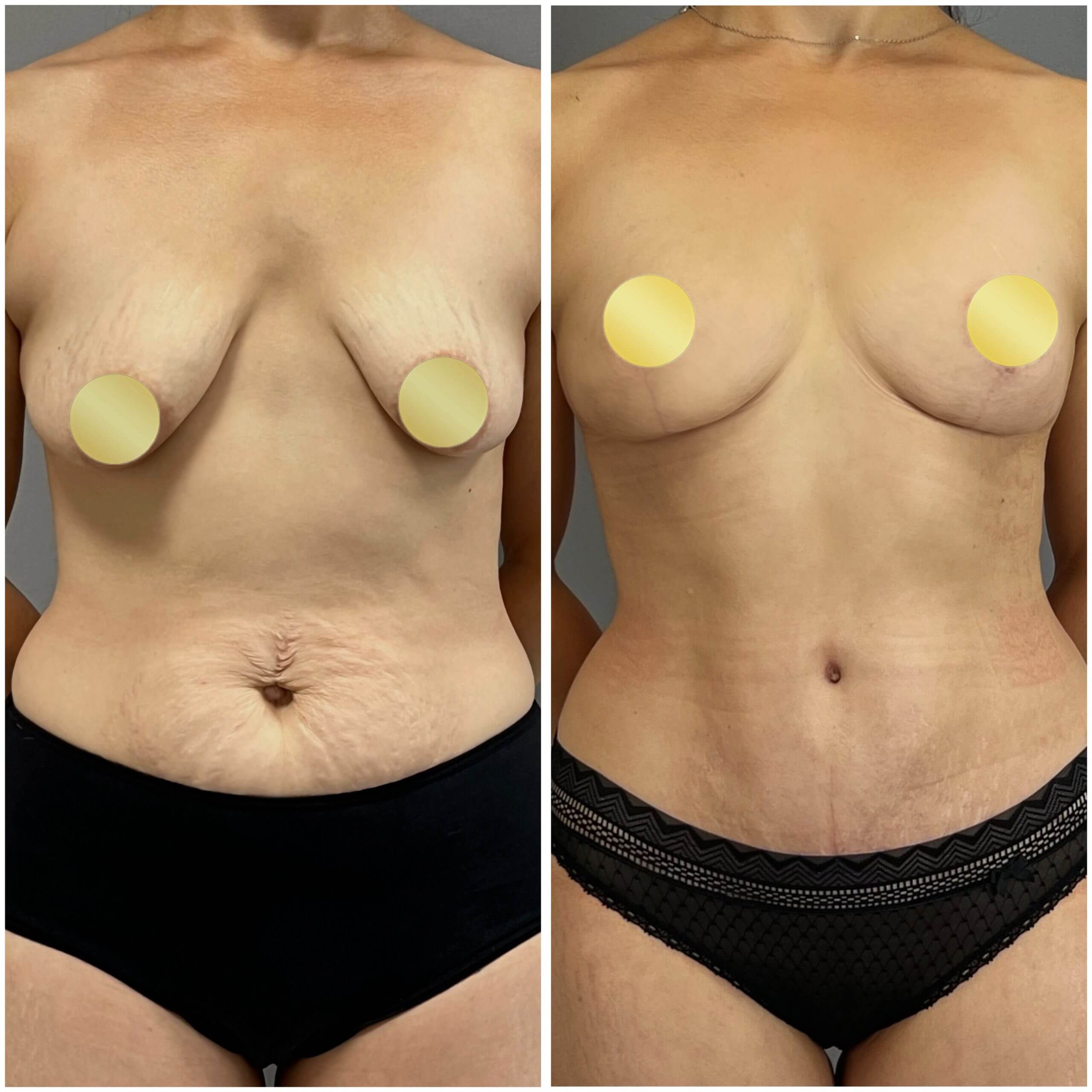 Подтяжка груди (мастопексия) 01