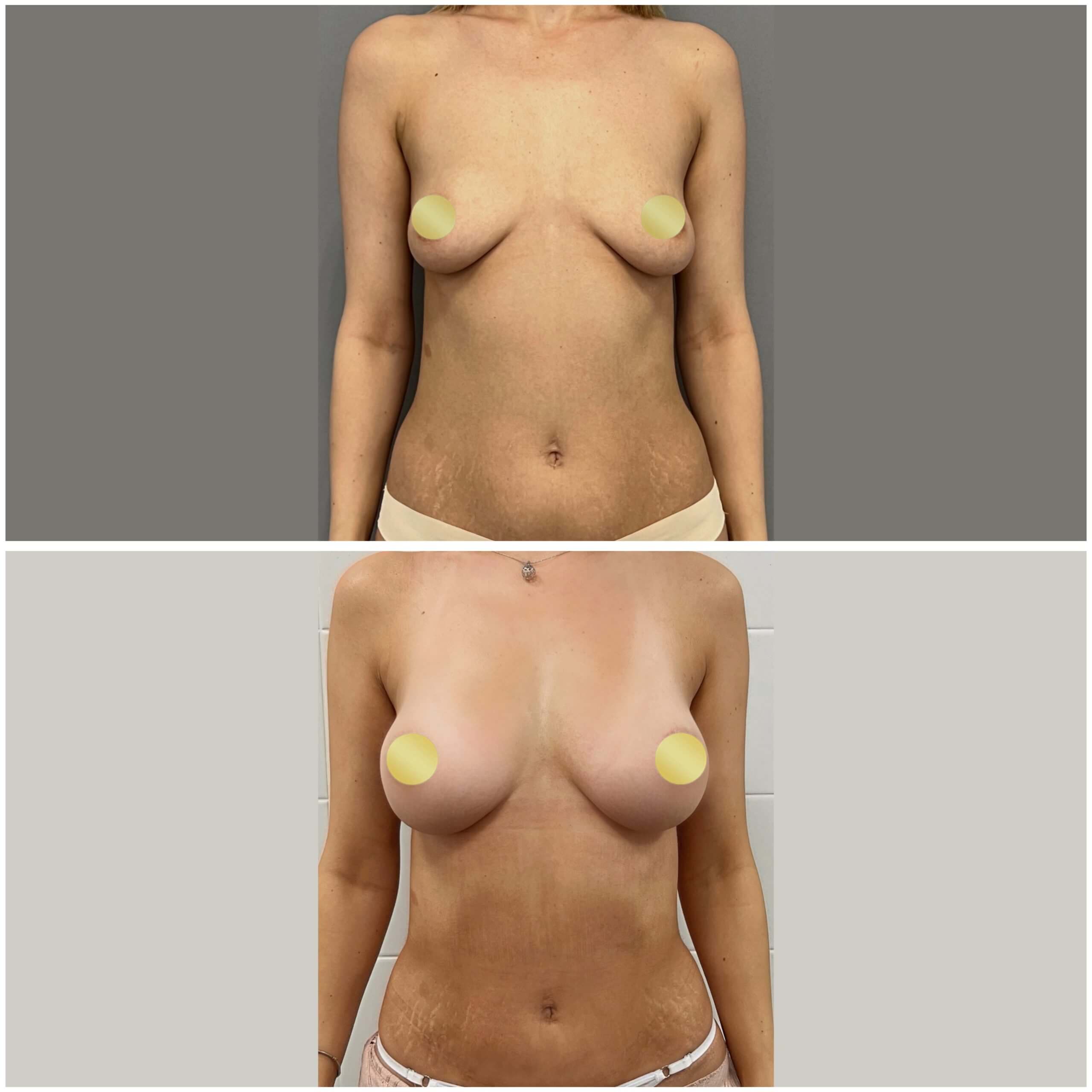 Липофилинг груди 01