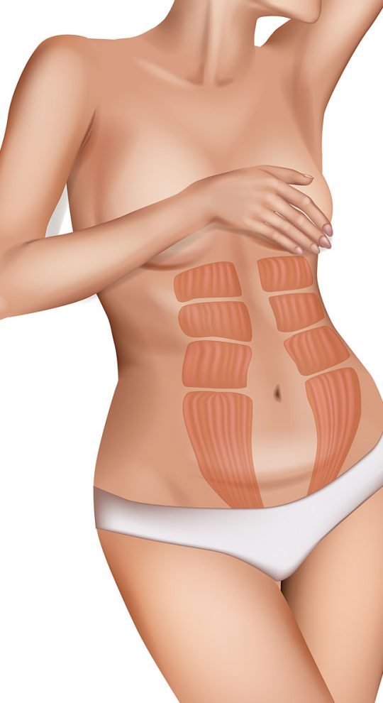 Миниабдоминопластика