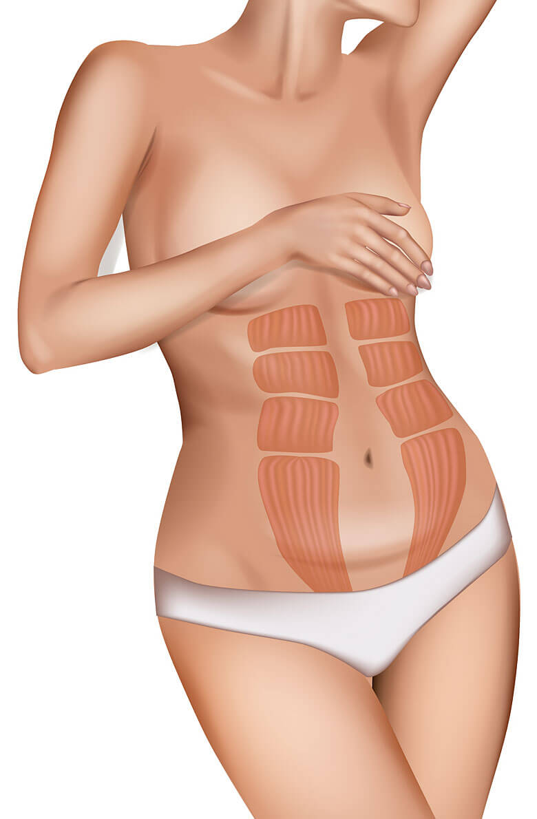 Миниабдоминопластика