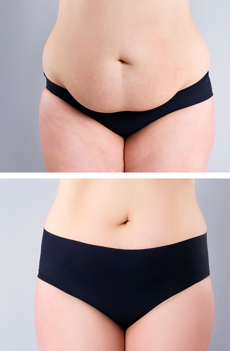 miniabdominoplastika-2