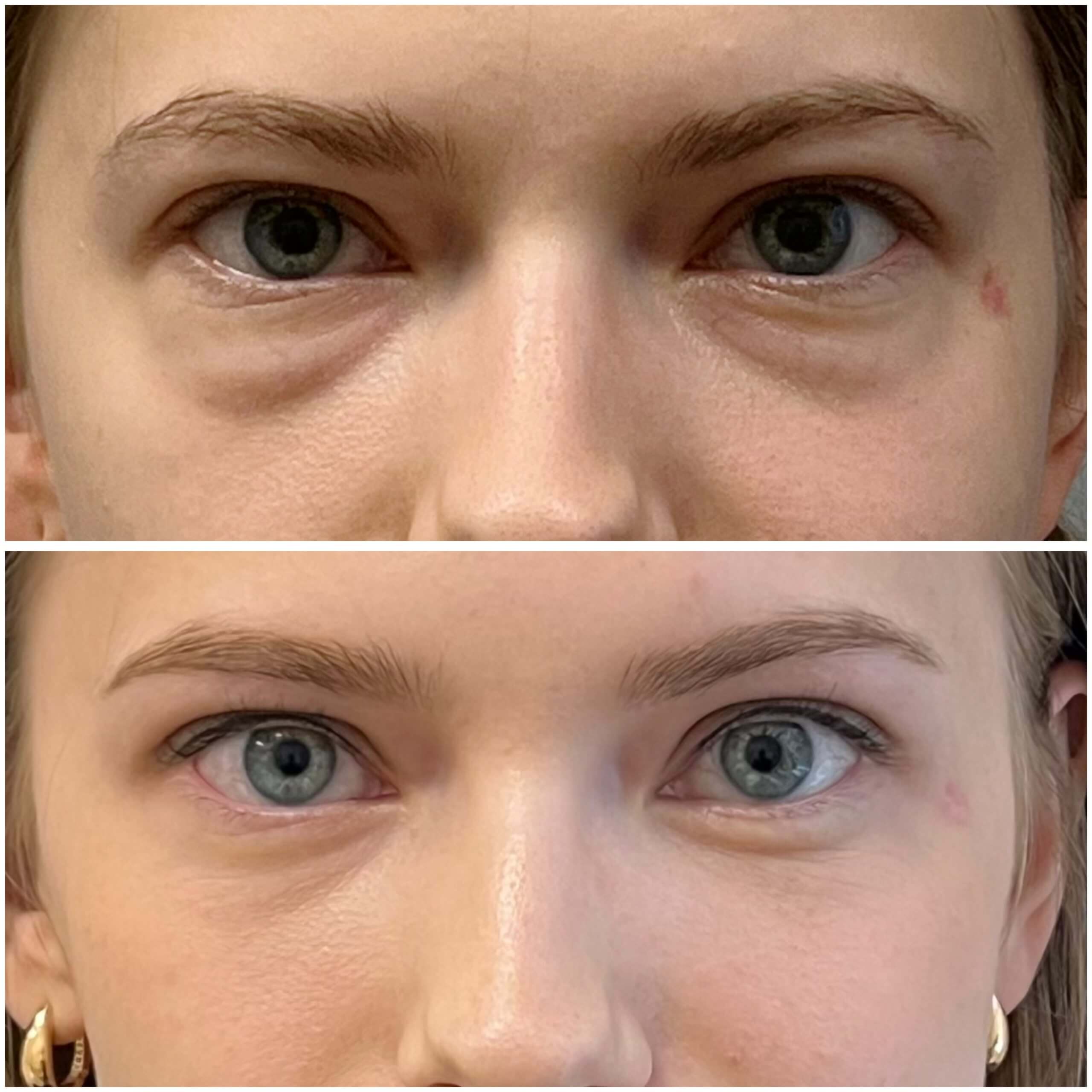 Нижняя блефаропластика 01