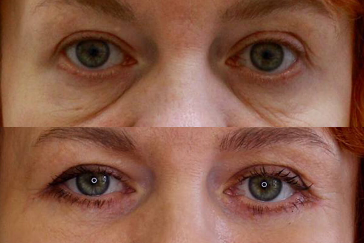 Нижняя блефаропластика 01