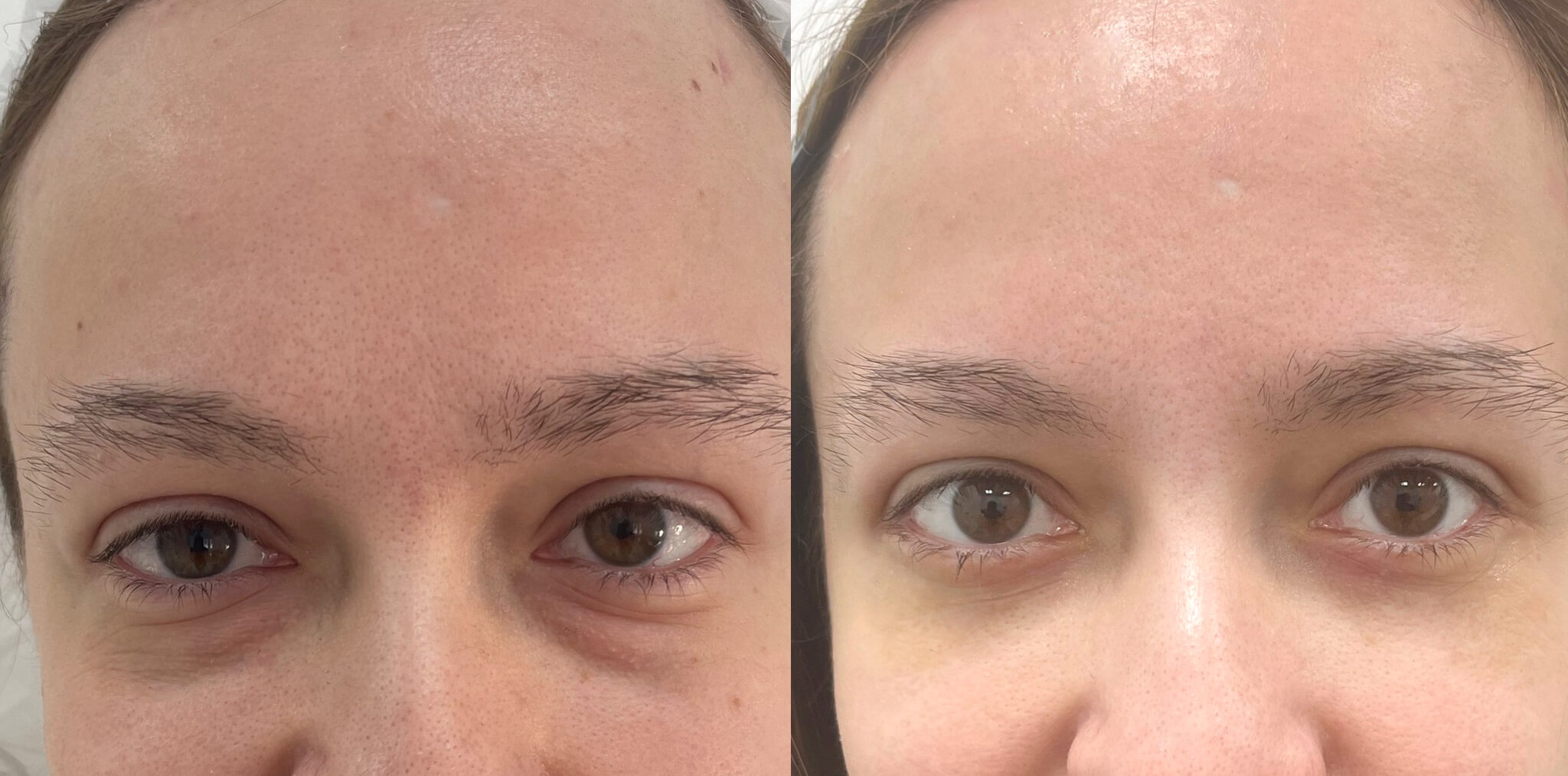 Нижняя блефаропластика 01