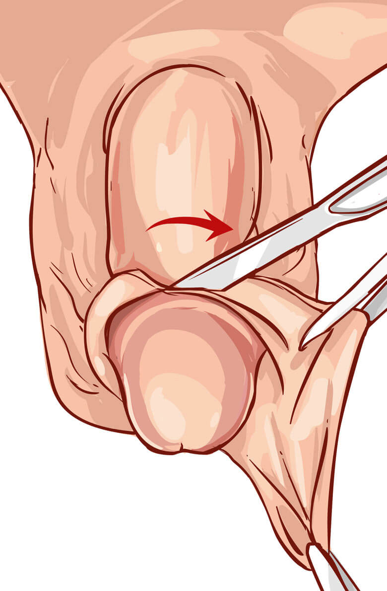 Интимная пластика у мужчин
