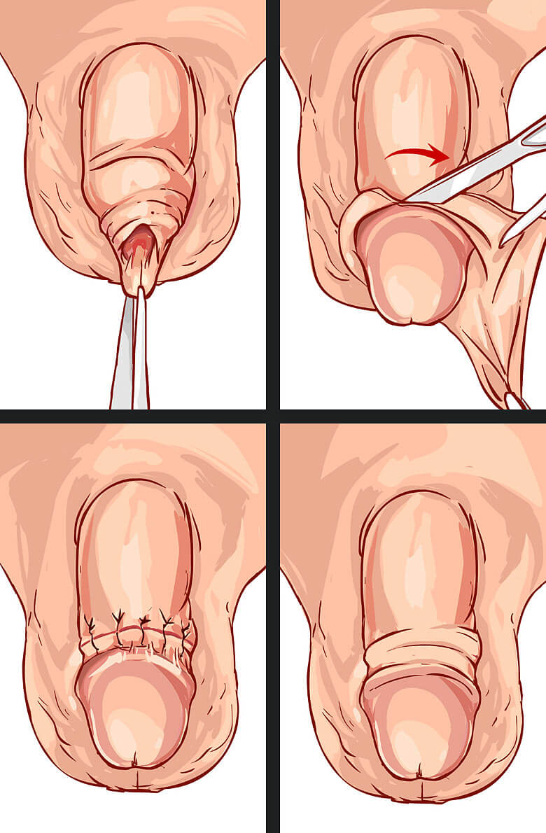 obrezanie-u-muzhchin-2