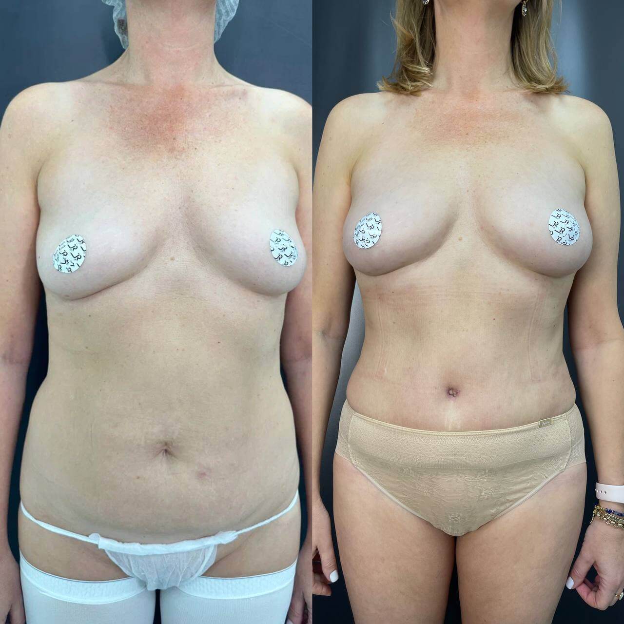 Ушивание диастаза 01