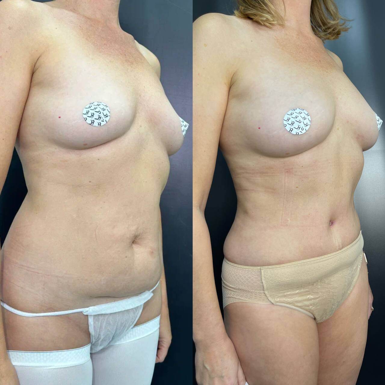 Ушивание диастаза 01