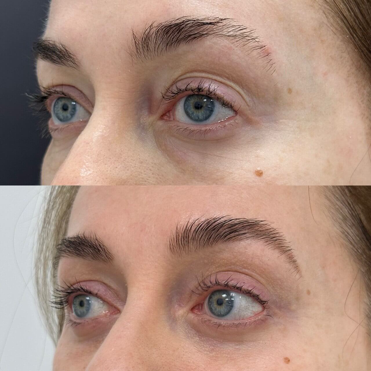 Нижняя блефаропластика 01