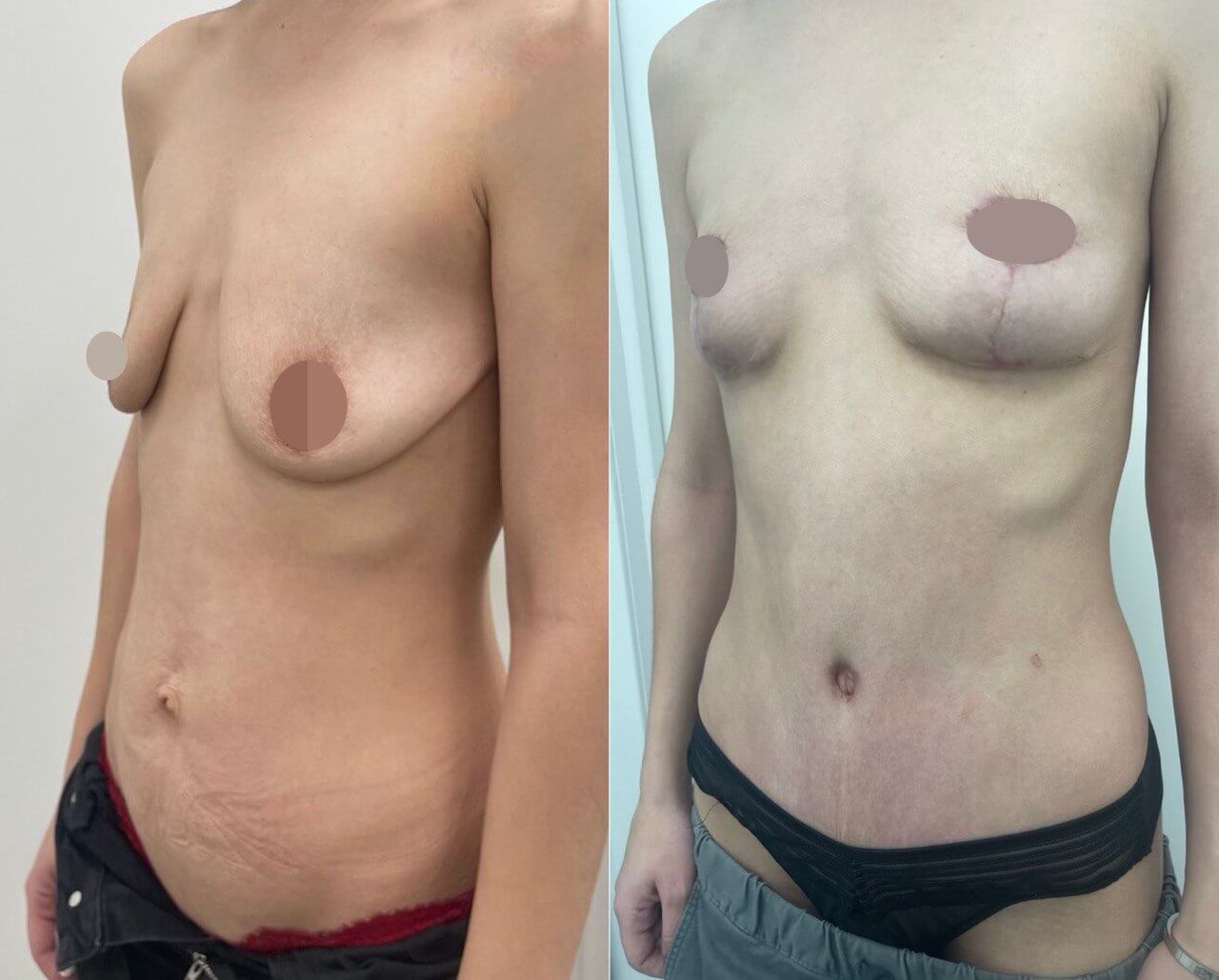 Подтяжка груди (мастопексия) 01