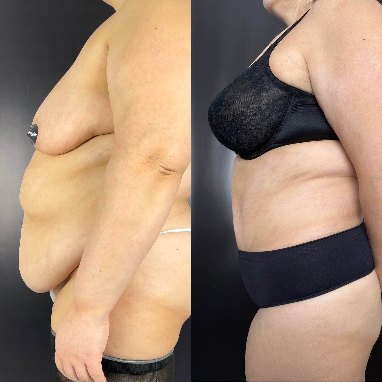 Абдоминопластика с переносом пупка 01