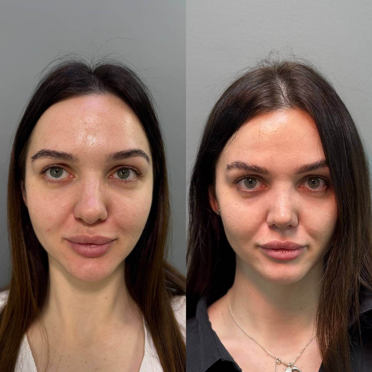 Ринопластика 01