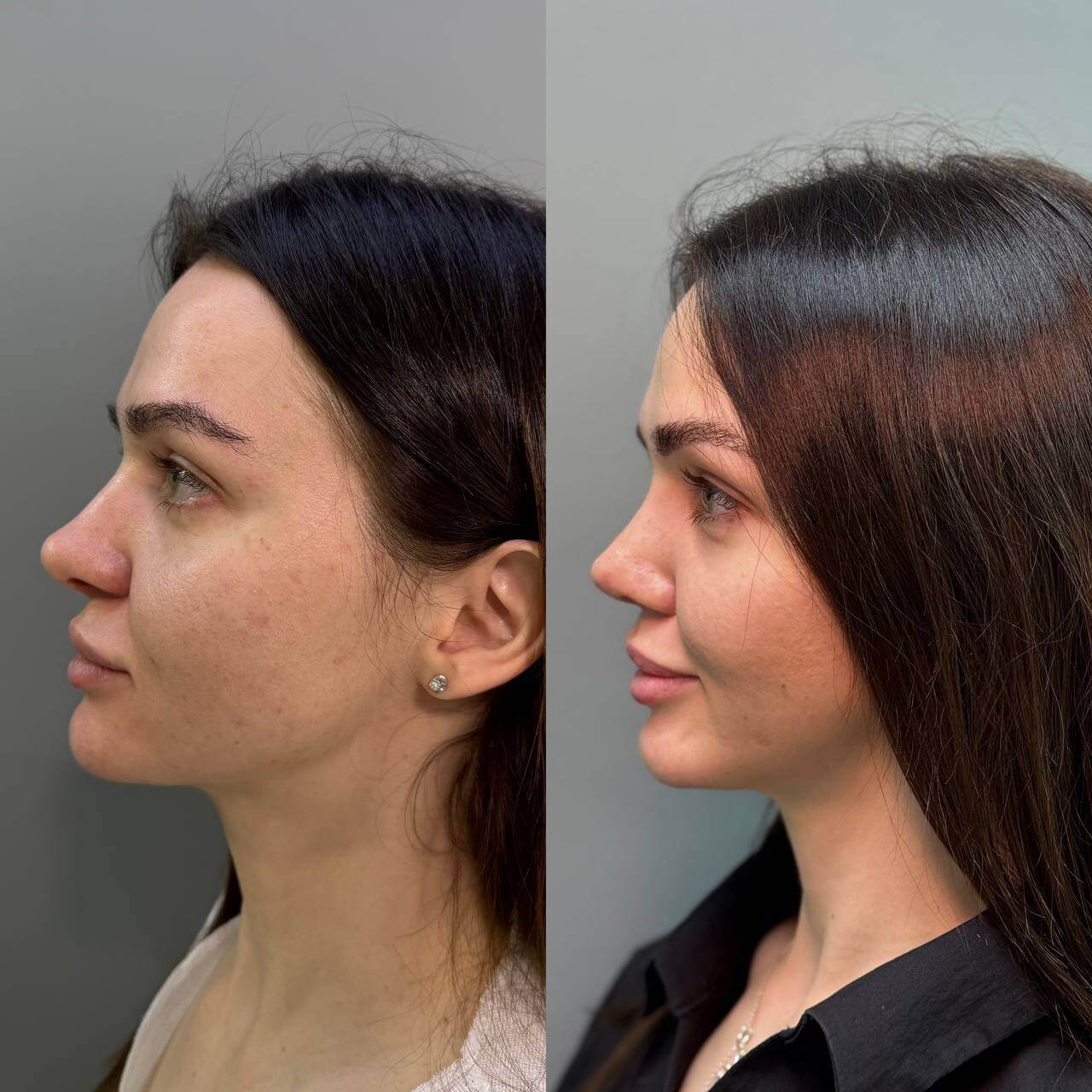 Ринопластика 01