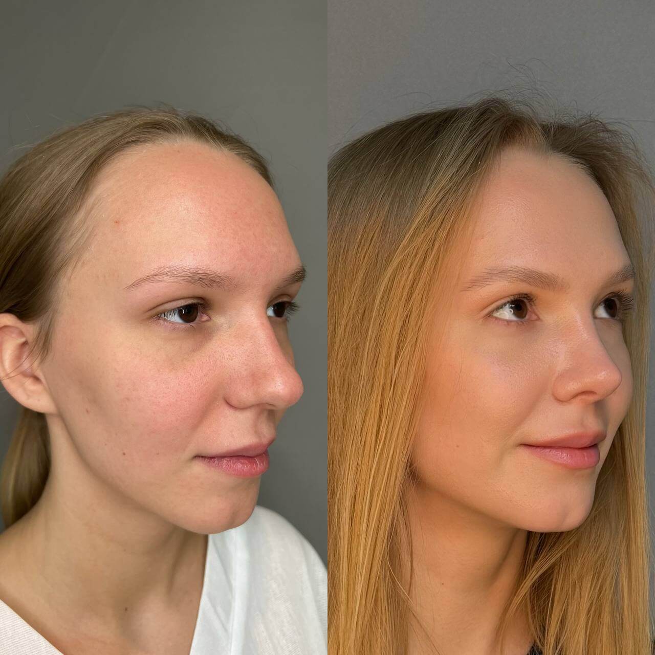 Ринопластика 01