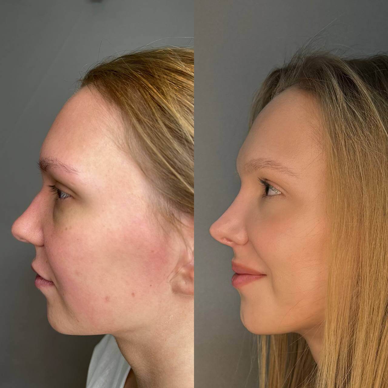 Ринопластика 01