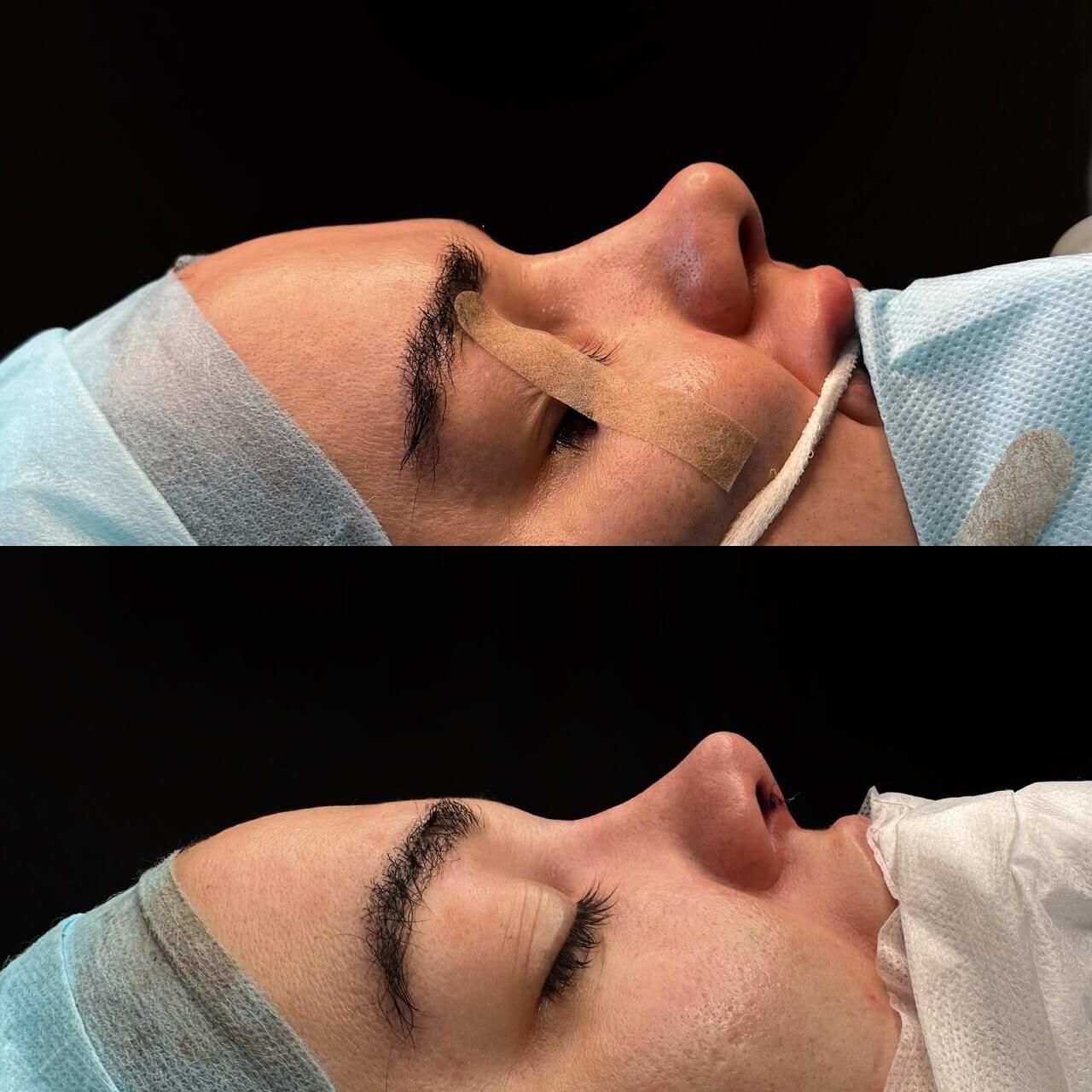 Ринопластика 01