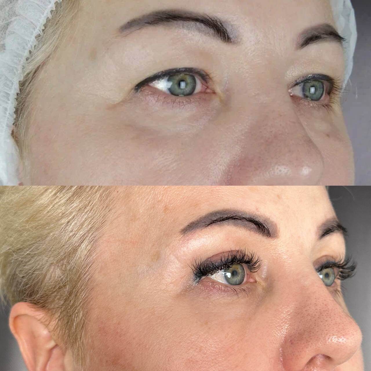 Нижняя блефаропластика 01