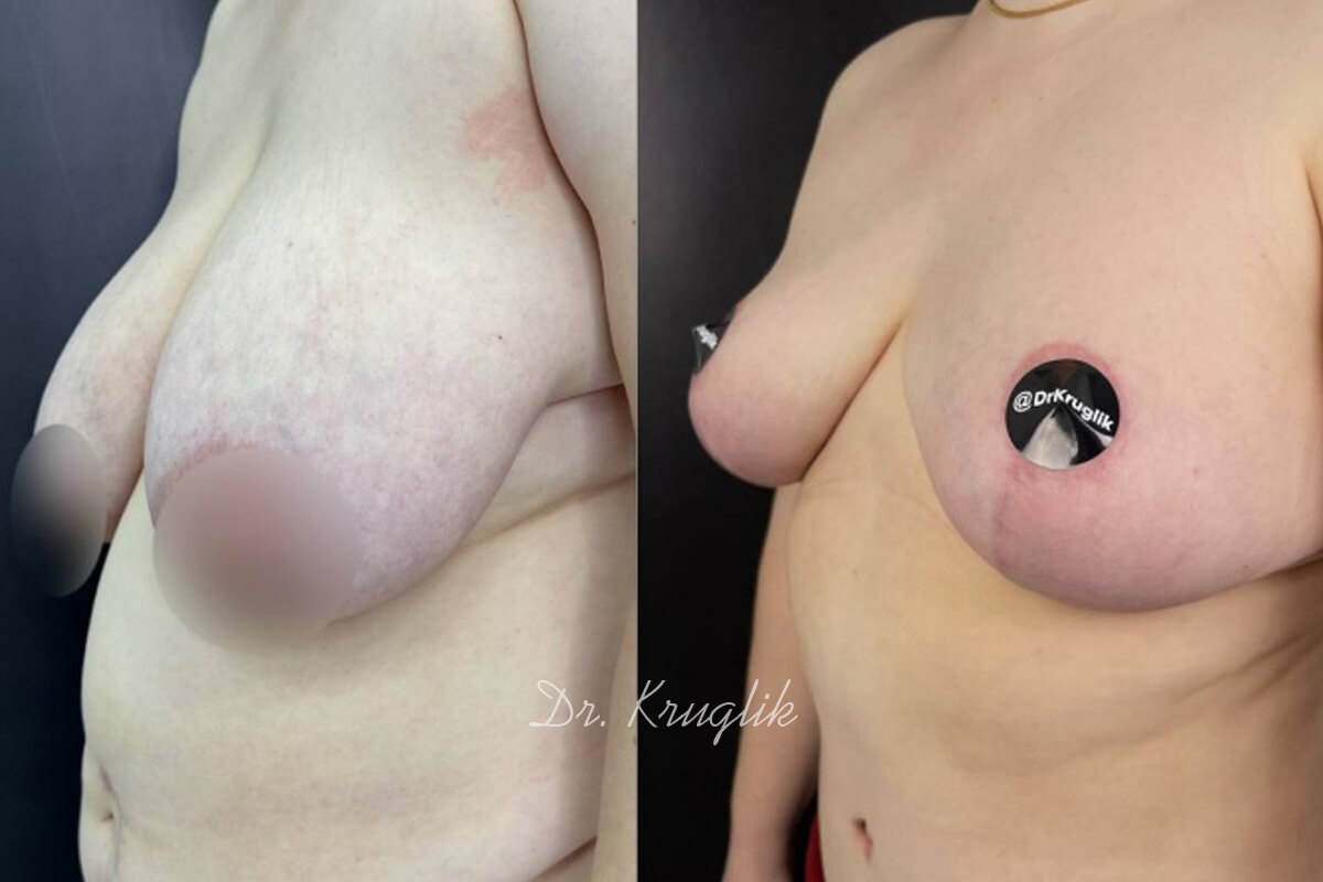 Уменьшение груди (редукция) 01